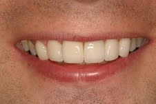 Cosmetic Dental Crowns