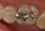 Composite-Fillings-Before-Image