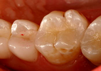 Composite-Fillings-After-Image
