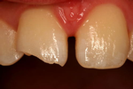Composite-Dental-Bonding-Before-Image