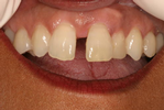 Cosmetic-Bonding-Before-Image