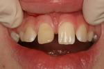 Composite-Dental-Bonding-Before-Image