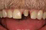 Crowns-Before-Image