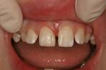 Composite-Dental-Bonding-After-Image