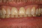 Crowns-After-Image