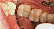 Replacing-Old-Fillings-with-Composite-Fillings-After-Image